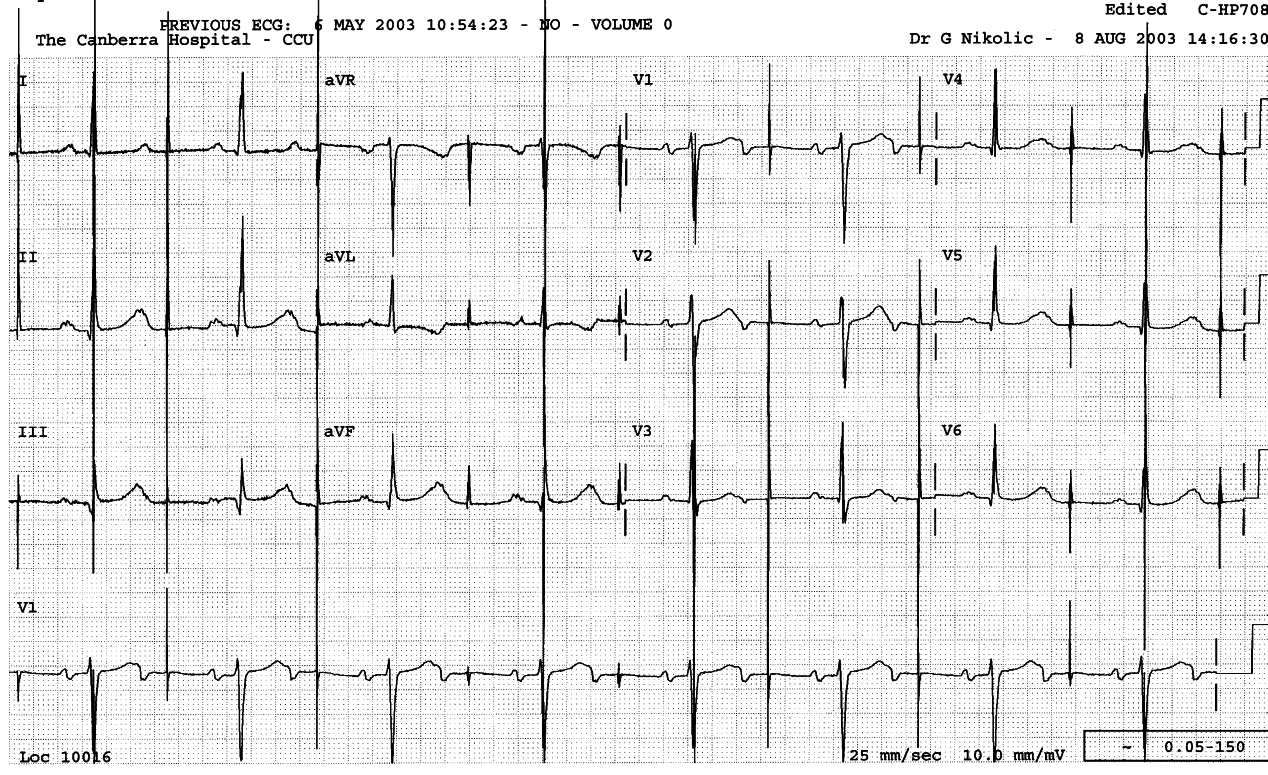 75 year old man in CCU , with a
permanent pacemaker. He is feeling unwell.