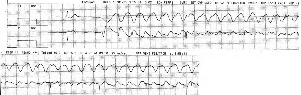 Continuous strip in the chart of a 35 year old lady with multiple arrests due to myocarditis. The recording was obtained after a bolus injection of adrenaline. 