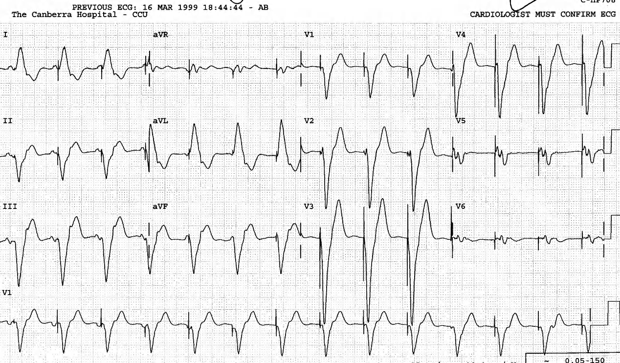 VVI ventricular pacemaker and dissociated sinus P waves. 