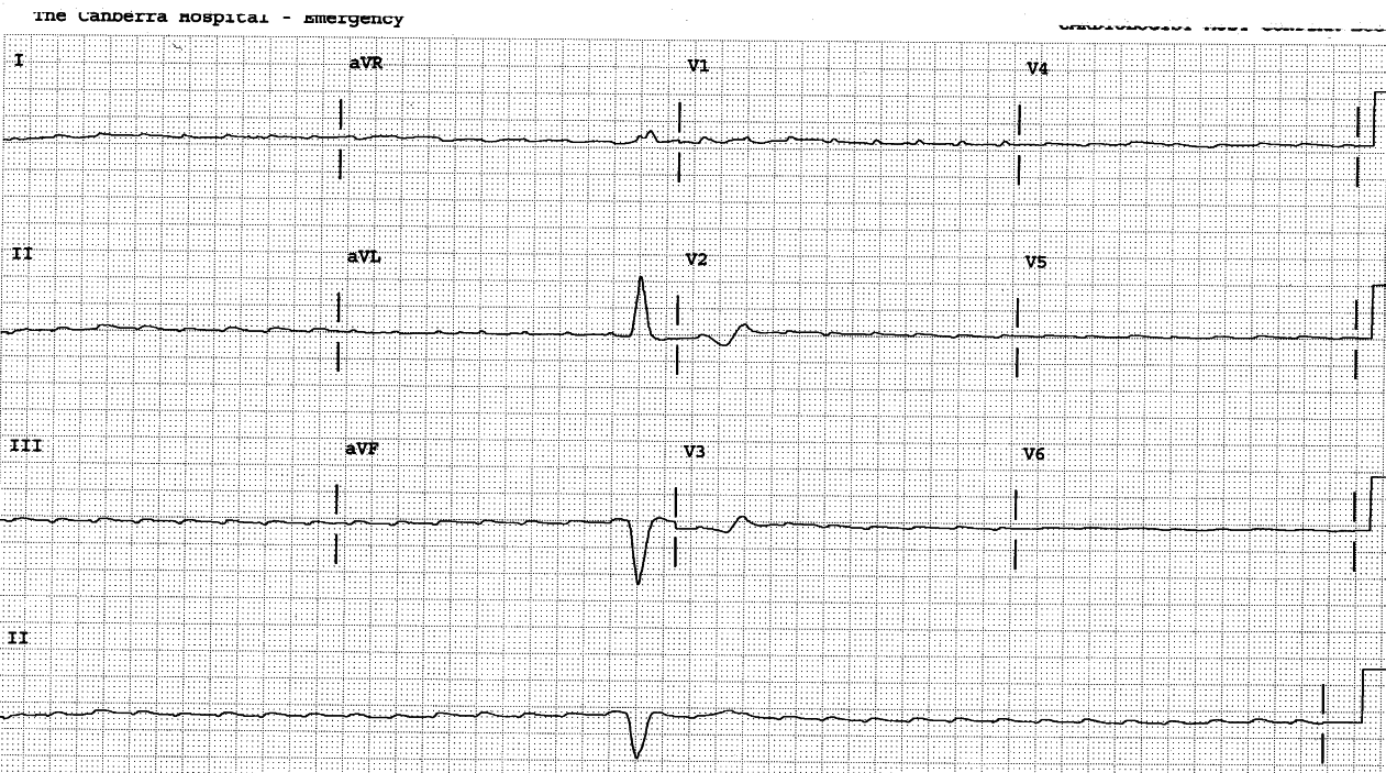 89 year old man digitalised for postoperative atrial fibrillation after an AAA repair. He had a long history of angina, cardiomegaly and ventricular arrhythmias. Give 3 reasonable explanations for the bigeminy seen in the bottom strip. 