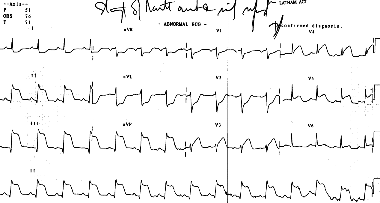 ECG taken before the AVB developed. The PT elevation cannot be discerned with certainty in this trace.