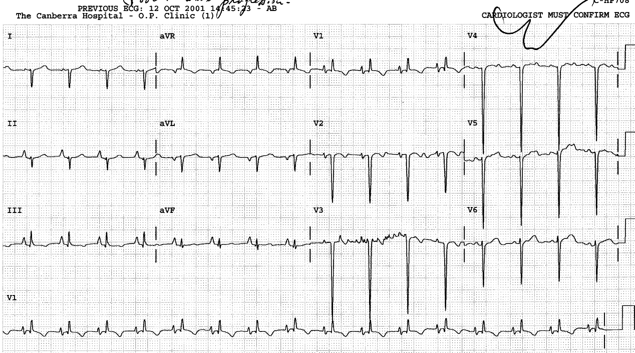 53 year old lady with advanced emphysema