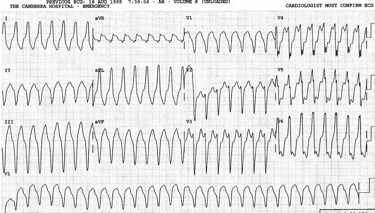 65 year old man with recurrent palpitations. He has normal coronary arteries and unexplained, selective dilatation of right-sided chambers. 