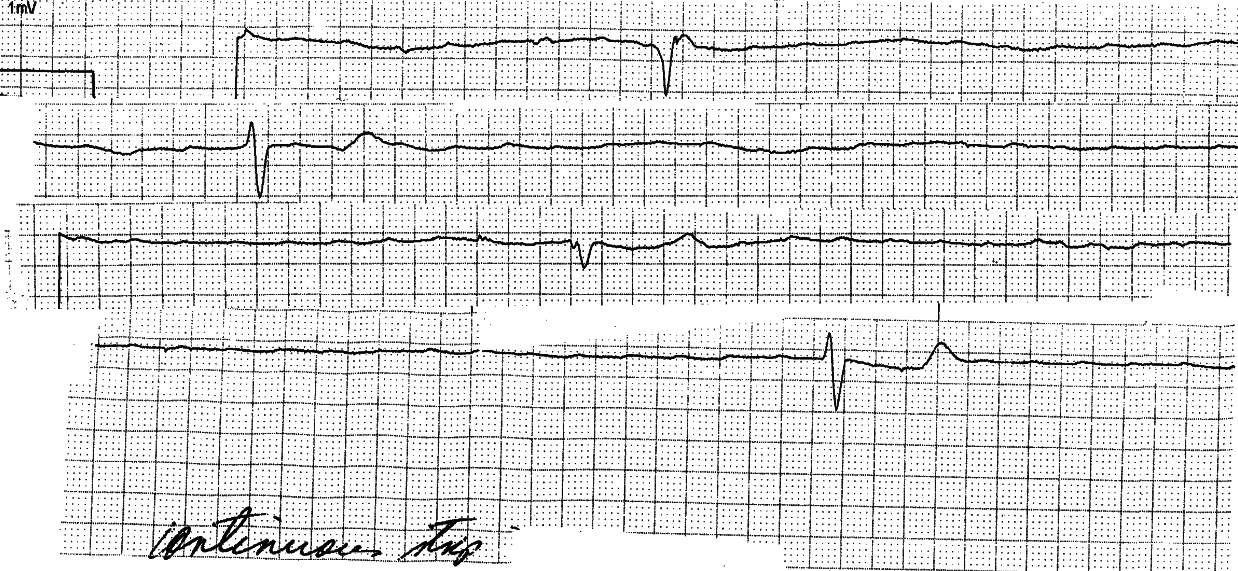 Semiconscious 74 year old man with inoperable coronary disease and LV failure. The BP in Casualty was 60/40 mmHg. 