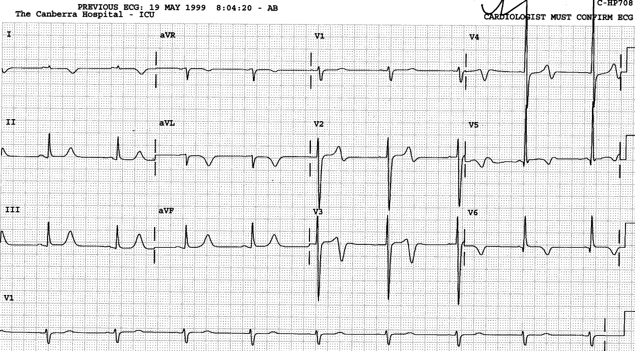 Ventilated 26 year old with traumatic intracranial bleed.