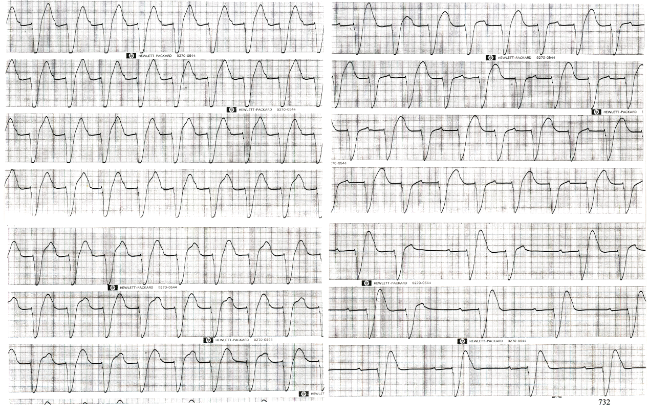 Agonal strips of a 63 year old man in coma hepaticum