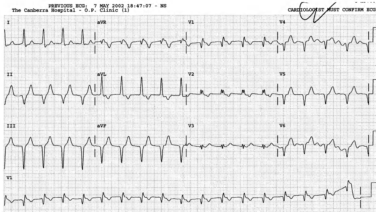 63 year old lady following PTCA complicated by a femoral artery tear. 