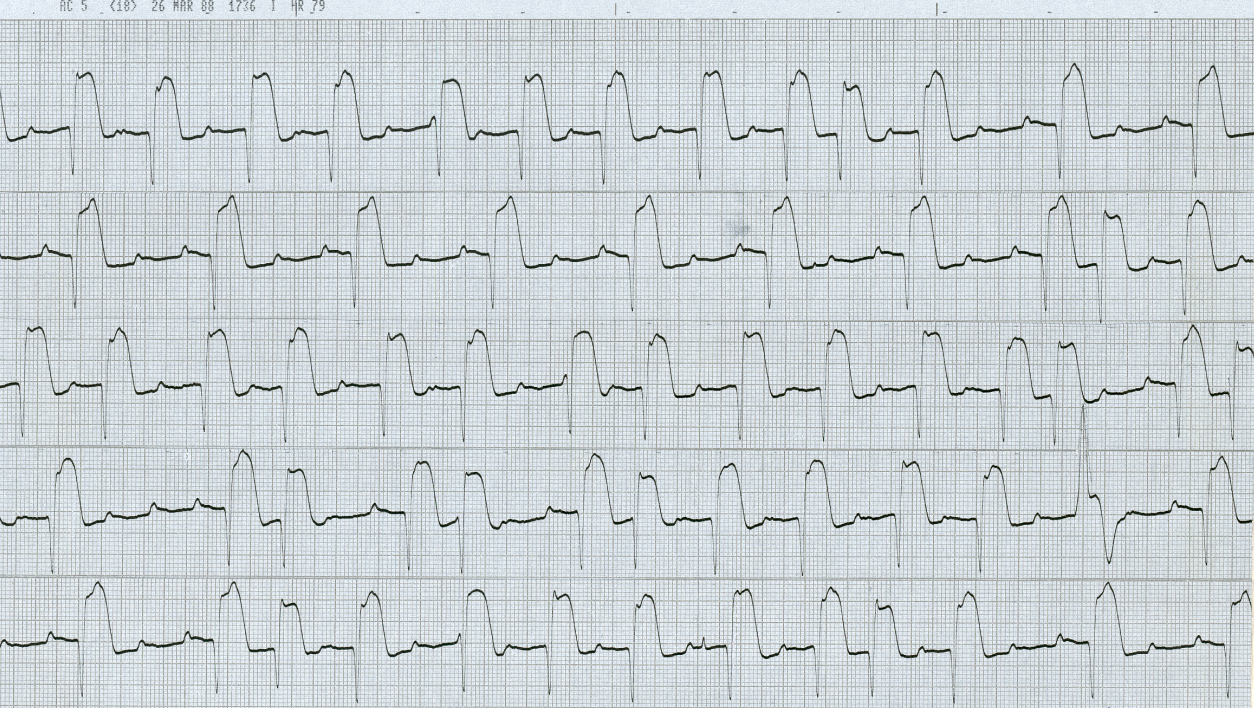 53 year old woman in the second hour of an acute inferior infarction. 