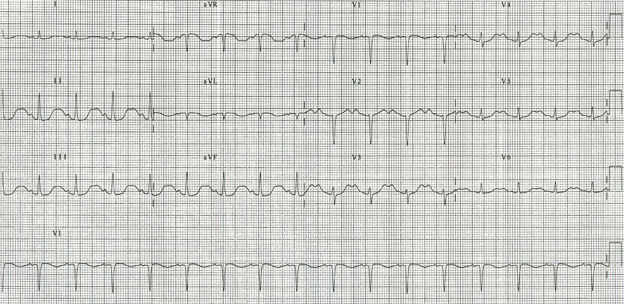 25 year old lady with manic-depressive psychosis, unconscious