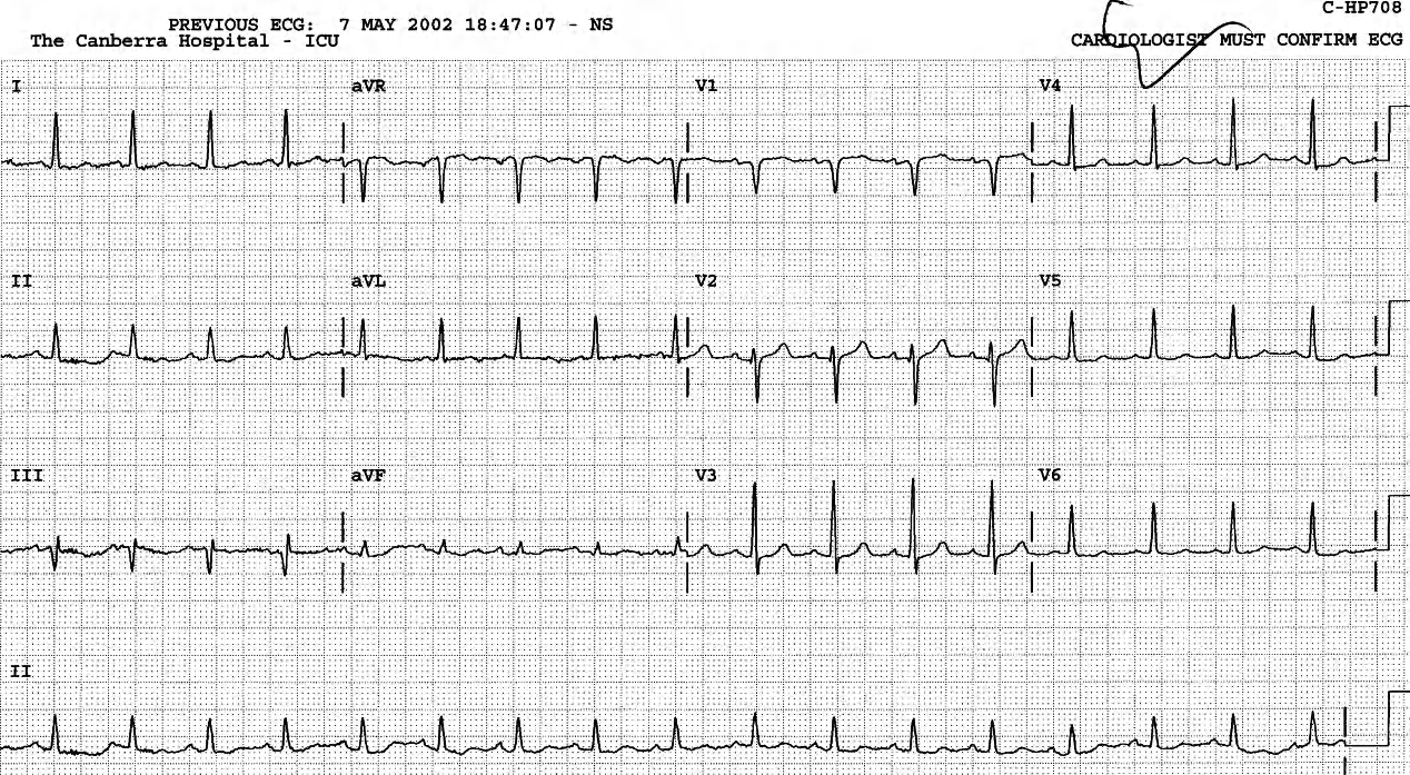 No septal q in V6 with smallish R wave, QS in V1 and qrS in V2 indicate an old septal infarction. 