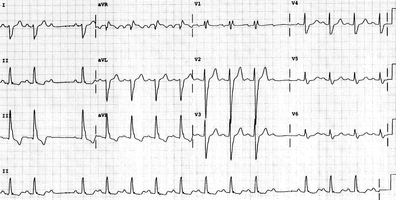 Perhaps the simplest description would be sinus tachycardia with variable 2o AV block! Not scholarly, but descriptive enough. 