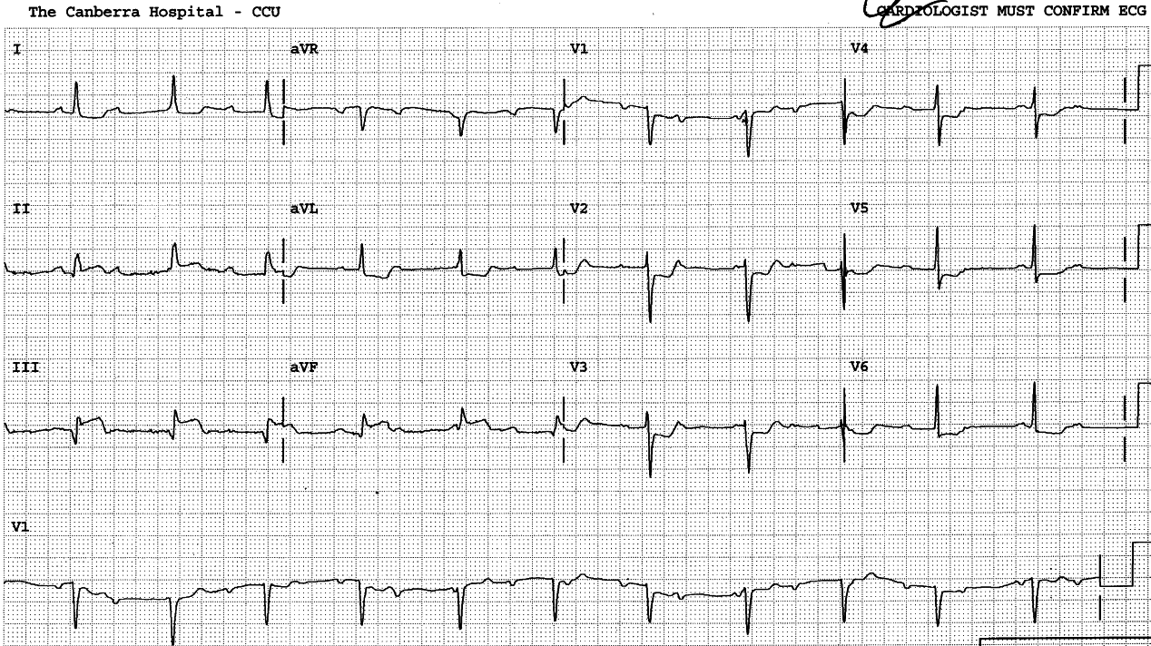 AV dissociation due to 3o AVB. Junctional rhythm is slightly accelerated at 69/min, but sinus tachycardia would still be expected to make some captures if it could. AVB, not AJR, stops it.