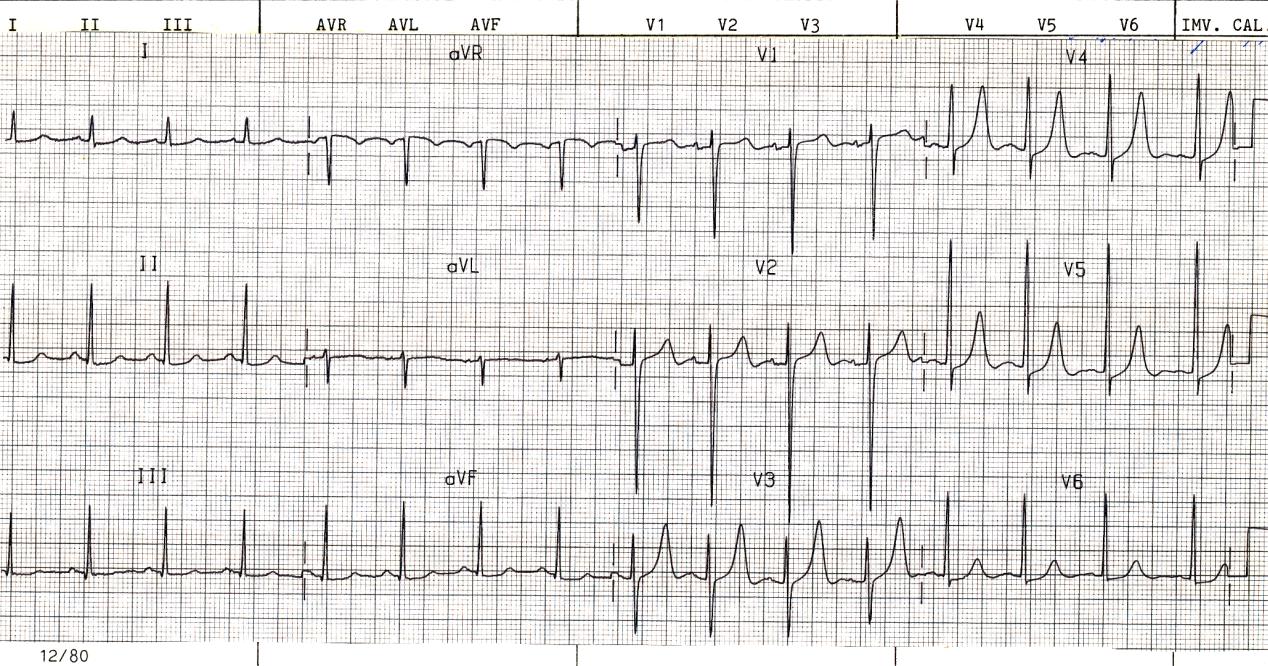 Normalised ECG a day later, with T waves suggesting an inadvertent, but understandable volume overload.