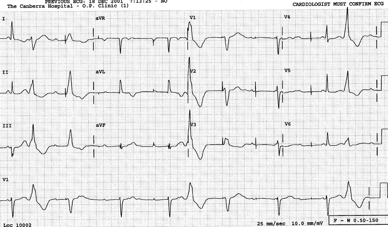 Admission ECG in 3o AVB. The temporary pacemaker has
climbed toward the RV outflow tract (lead 2 positive) and operates on a
hit and miss basis. The VEBs have the same morphology as in the two
previous tracings.