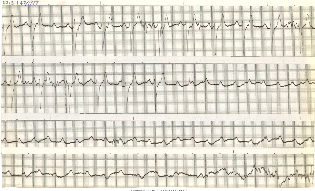 Cardiogenic shock in a 46 year old man with new     LBBB. 