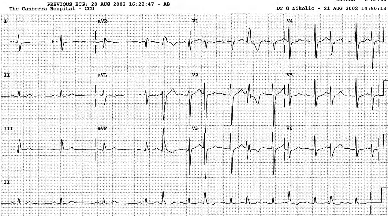 Asymptomatic 76 year old man with a history of CABGs. 