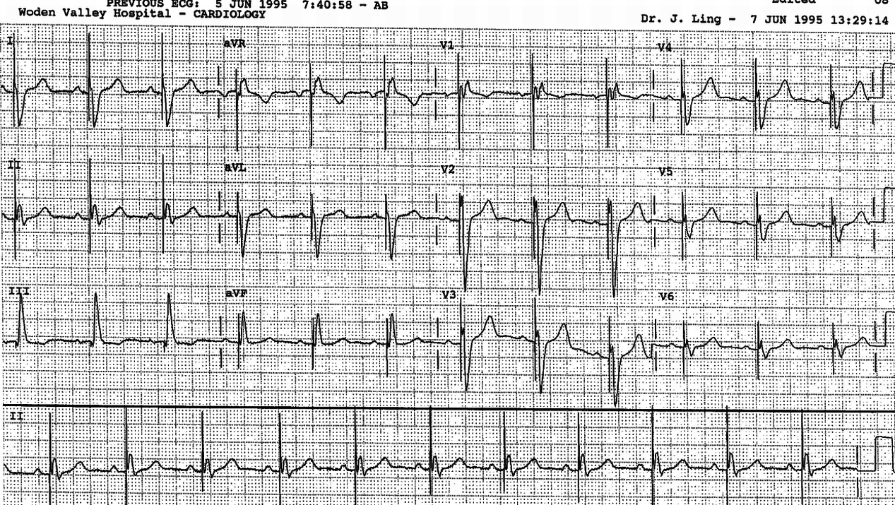 77 year old man with recurrent pre-syncope over the past fortnight. 