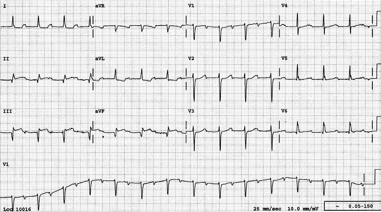 1o AVB with PR interval 0.40â. This is where Bix rule should be considered: is another P wave hiding half-way, in the QRS complex? Unlikely in this case: the atrial rate would have to be 168/min if 2:1 AVB were present.