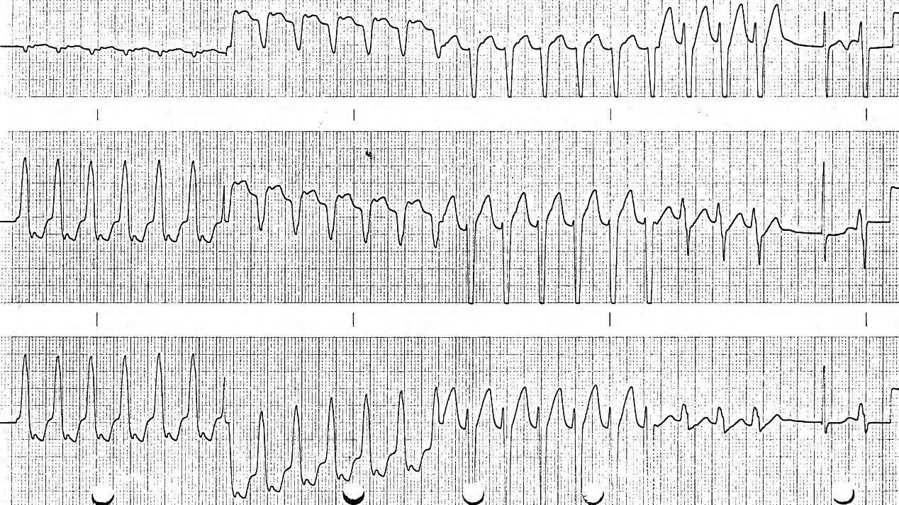 Tachycardia in a 63 year old man with intermittent dizziness and sweating 9 years after a myocardial infarction. Xylocaine in Casualty cured it. 