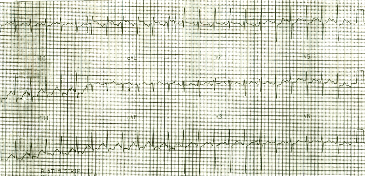 Ventilated 26 year old man with pulmonary Ådema of the right lung and hypoplasia of the left pulmonary artery