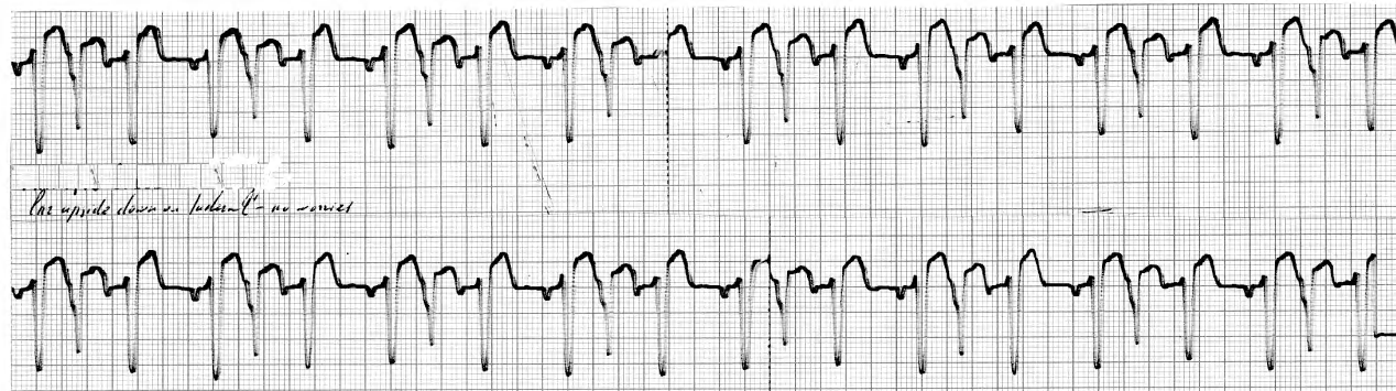 51 year old man on propranolol for myocardial infarction 8 months previously. His car rolled upside down during a dizzy spell. He was uninjured and crawled out of the car without   experiencing surprise, let alone fear or anxiety .