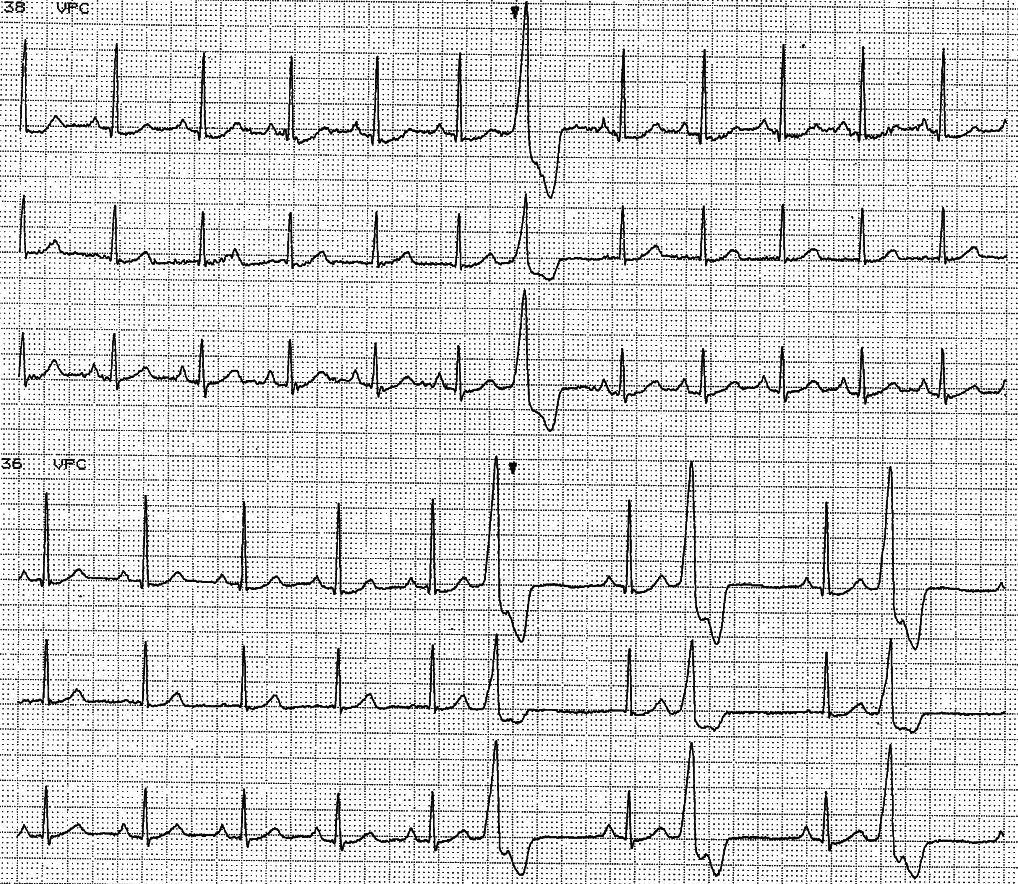 Holter recording of 47 year old lady with no cardiac history, asleep. She complained of palpitations during the day. 