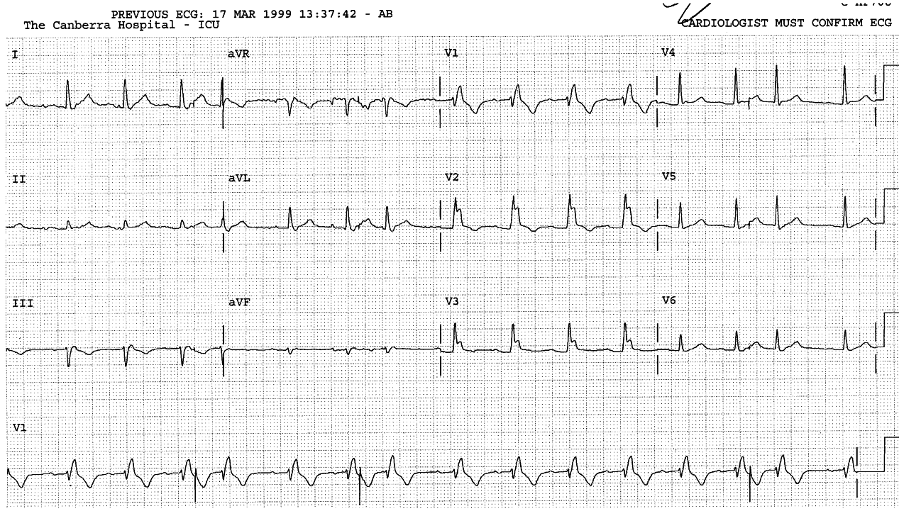 79 year old man in ICU following CABGs.