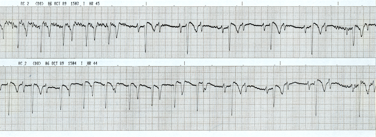 37 year old jogger with progressive exertional angina over 6     weeks. His 12-lead ECG is normal except for a 1o AV block. He     remains asymptomatic during the recording shown below. 