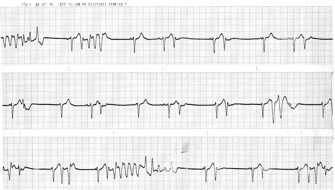 Irritable heart in a 61 year old woman with hÃ¦morrhagic pancreatitis. There was no other evidence of heart disease. The electrolytes were normalised. 