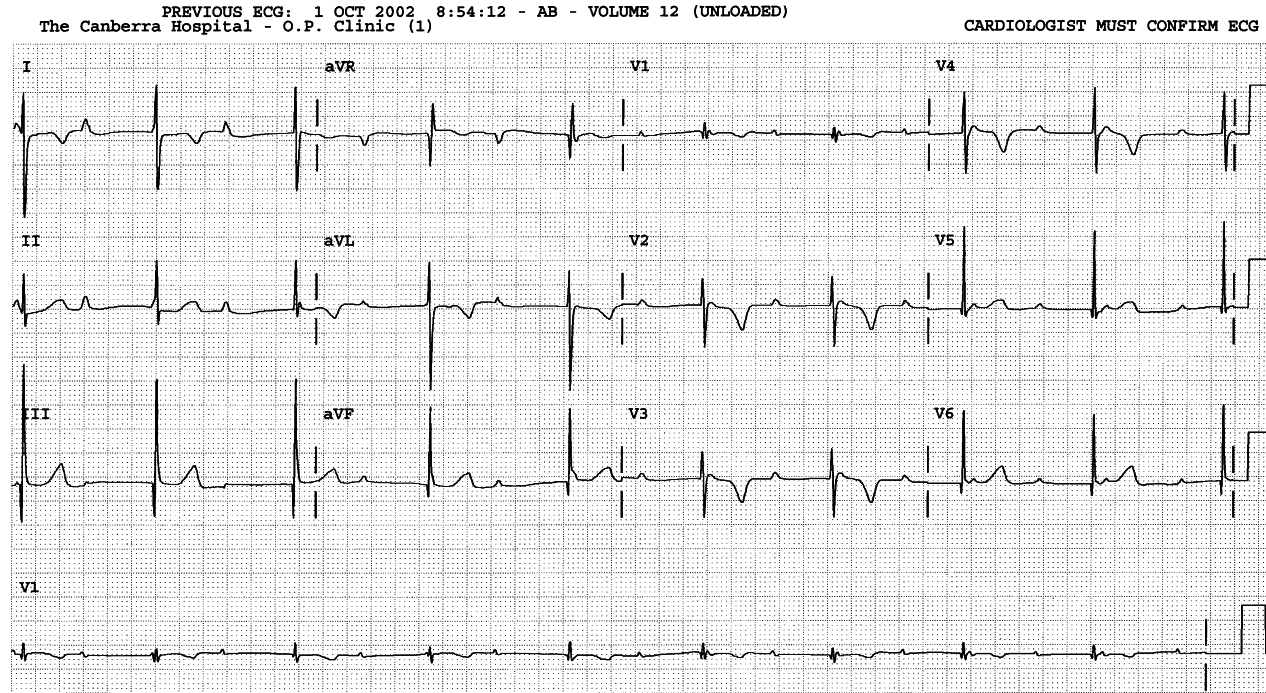 Same Holter study. Frequent uniform (unifocal) VEBs. There is no retrograde conduction, concealed or otherwise; indeed, the pauses are now fully compensatory. 