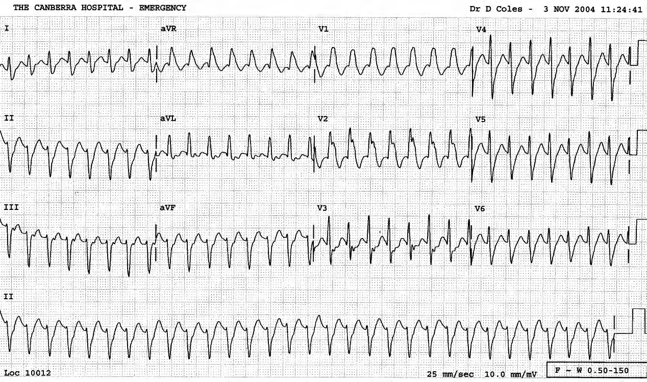 Symptomatic tachycardia in a 31 year old man with myocarditis. 