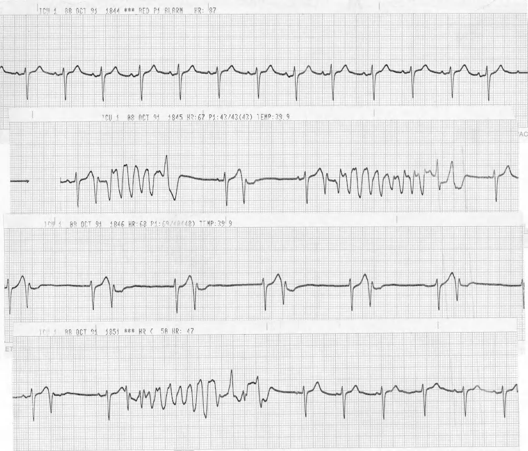 Faster sinus rate did not protect against the runs of multiform VT. 