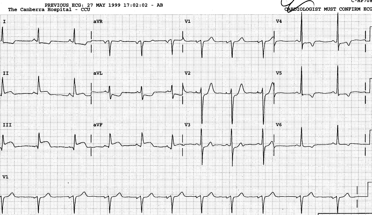 The anterior T wave inversion may well be due to the current infarction, or may have pre-existed for other reasons.