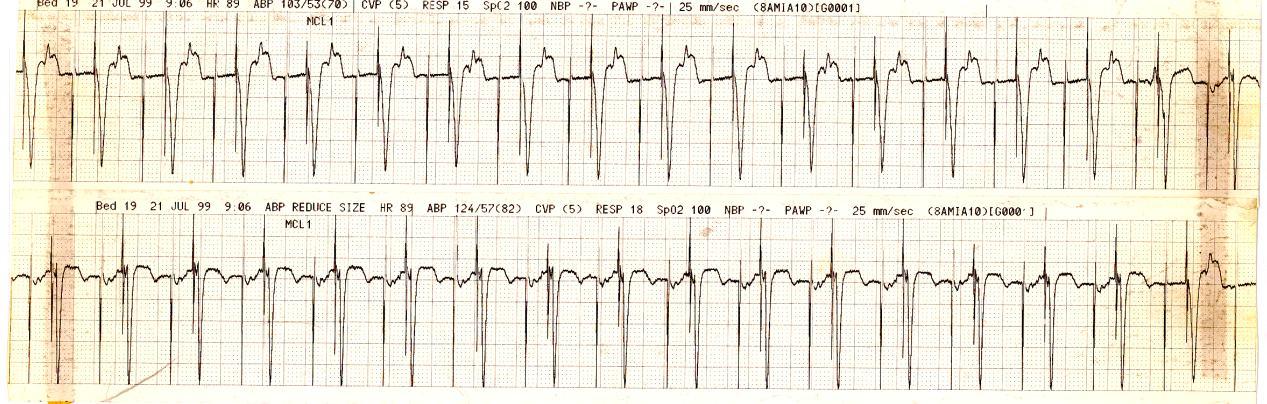 72 year old man sitting in a chair day after triple CABG.
Without any movement or interference, his blood pressure varies as
recorded. Why?