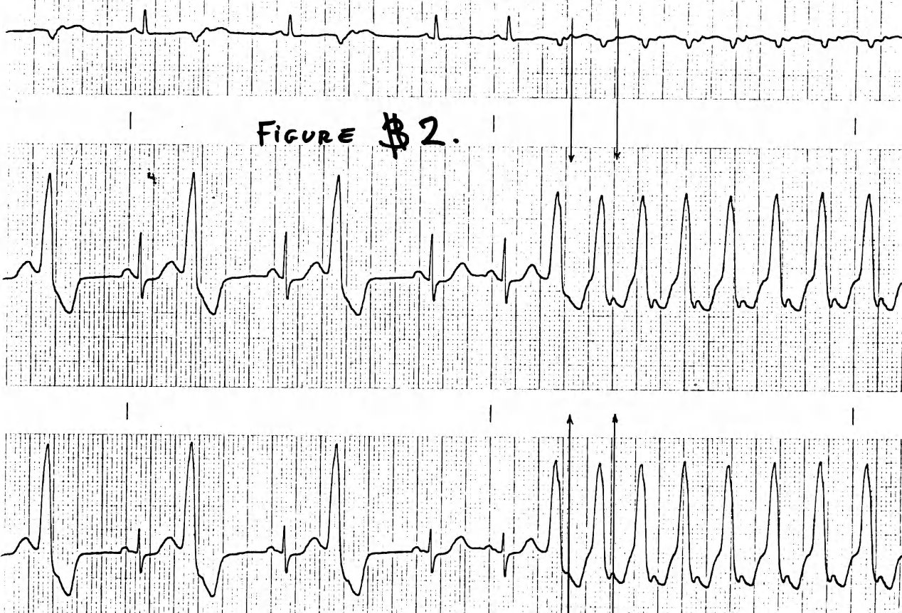 Beats with and without retrograde P waves. 