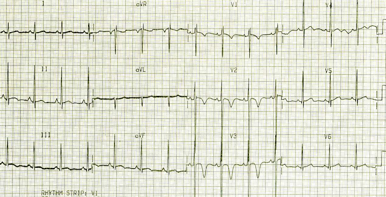 Evolving like any other acute cor pulmonale.