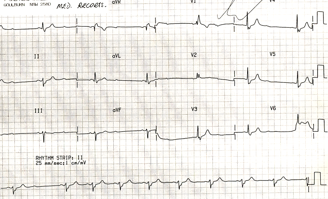 Asymtomatic 75 year old man who slowed down to speed     up. 