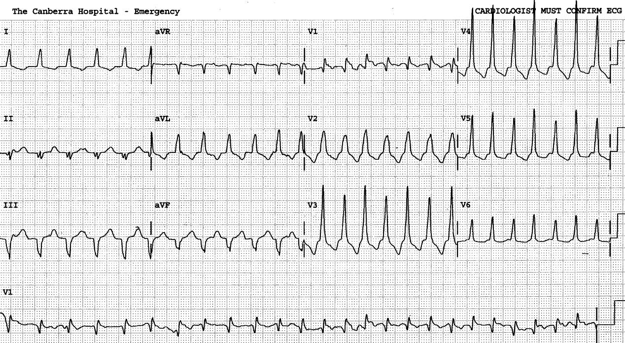 43 year old lady transferred from a peripheral hospital with thrombolysis on the way.