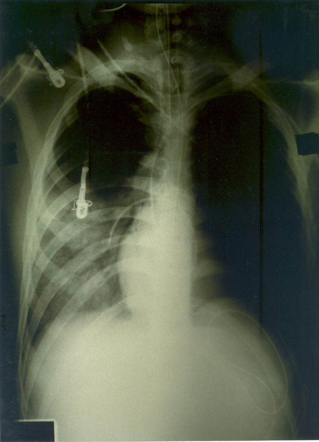 CXR showing the distribution of the Ådema. Left hilum looks empty.