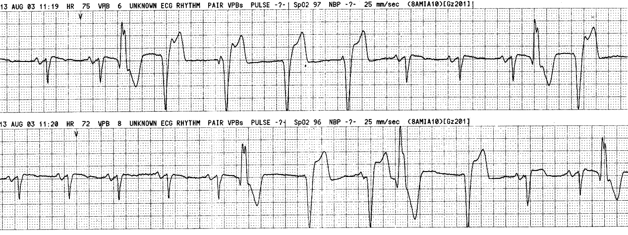 The VEBs are sensed in the lower strip. Third last complex is a
fusion beat.