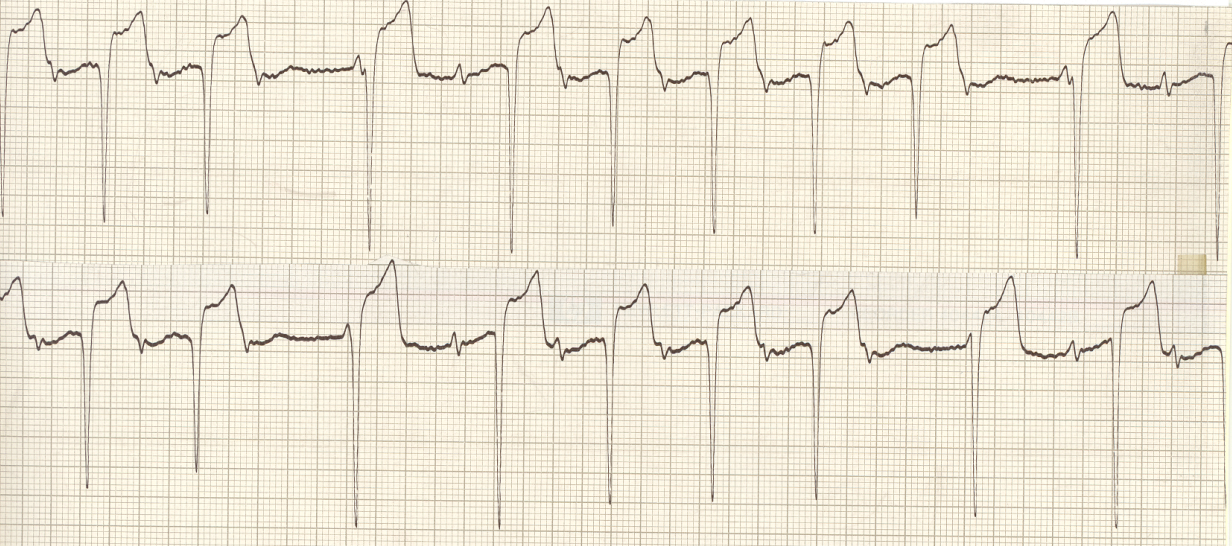 The Wenckebach progression is imperceptible in terms     of PR prolongation before the dropped beat here 1 ; the initial beats in each     sequence are obviously dissociated from the preceding P waves, while the     following ones (in each large-QRS pair) have a conductable PR interval     while their QRS size suggests dissociated, junctional origin. Fusion     from two supraventricular foci is extremely rare and there is nothing in     the second large QRS to suggest it by way of size intermediate between     the obviously junctional and onviously sinus beats. Examples of     non-phasic aberration in junctional beats are discussed in the     Ventricular Conduction volume. 