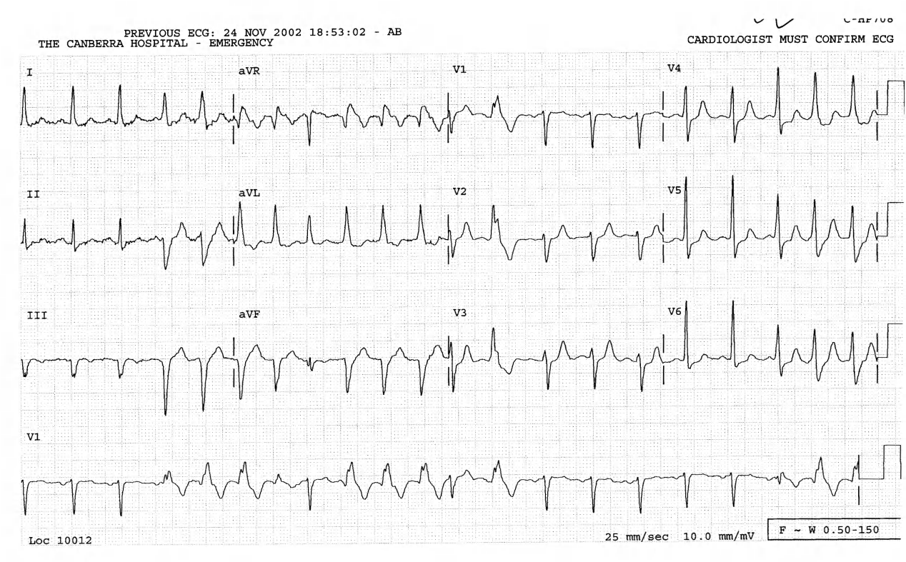 Routine admission ECG of a 70 year old man with ischÃ¦mic foot from a thrombosed popliteal aneurysm. 