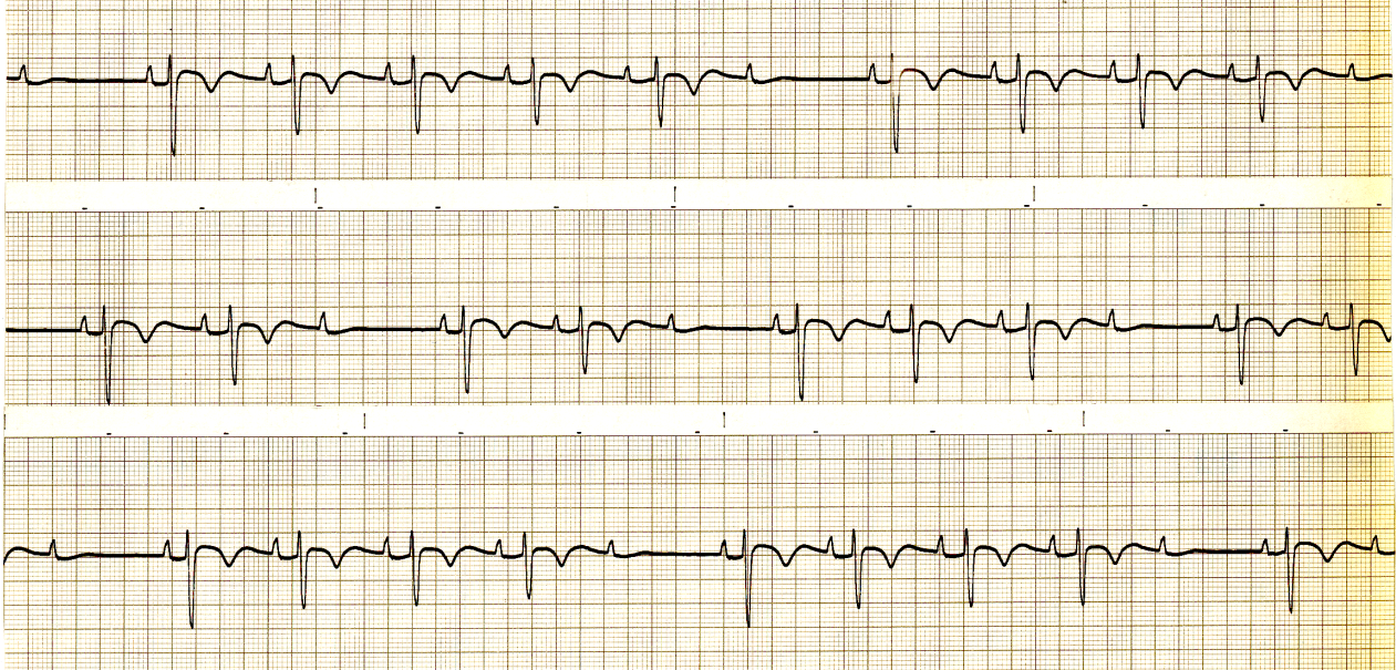 Lead 2 strips in a 81 year old woman with inoperable bronchogenic carcinoma. She had been digitalised for atrial fibrillation.