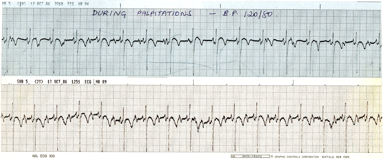 Same patient, day after. It is easier to see that PR intervals are all different. 