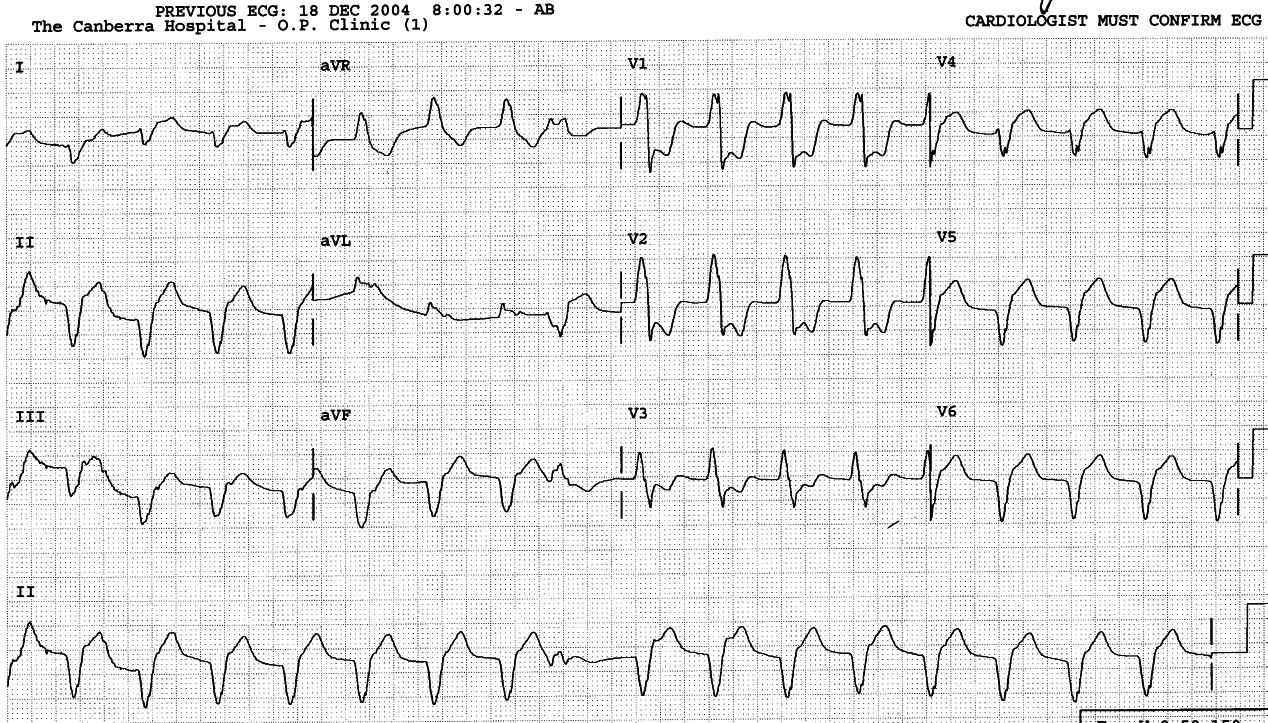 AIVR on current admission, with inferolateral MI pattern.