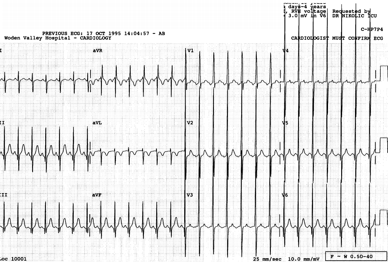 Four months old baby with pansystolic murmur and thrill