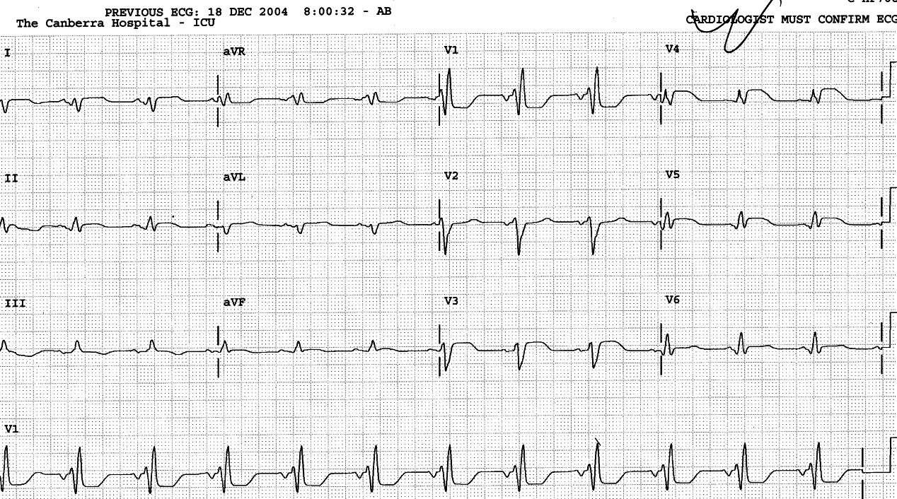 83 year old man with chest pain and known chronic RBBB.