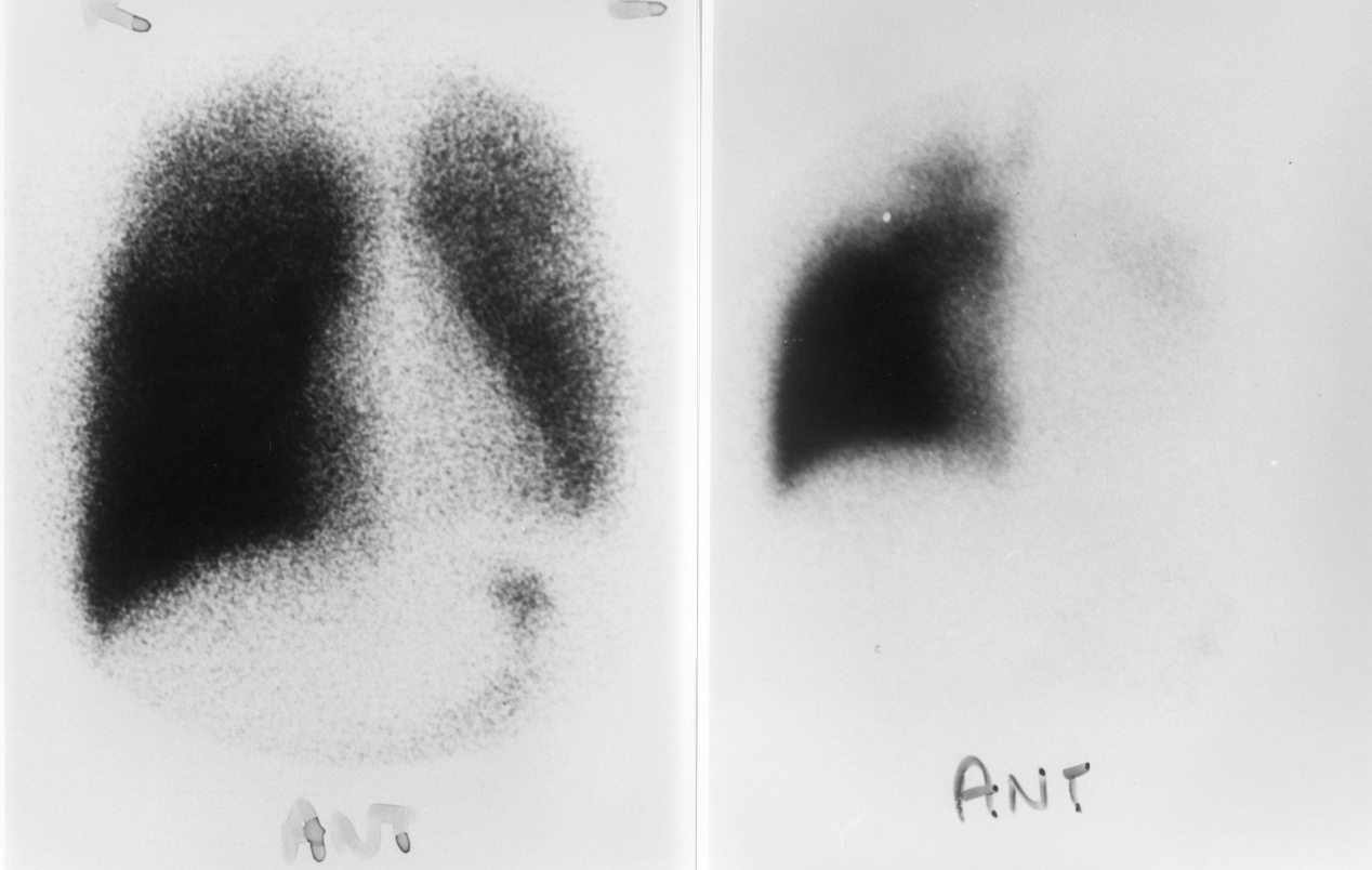 V-Q scan. Ventilation is on the left.