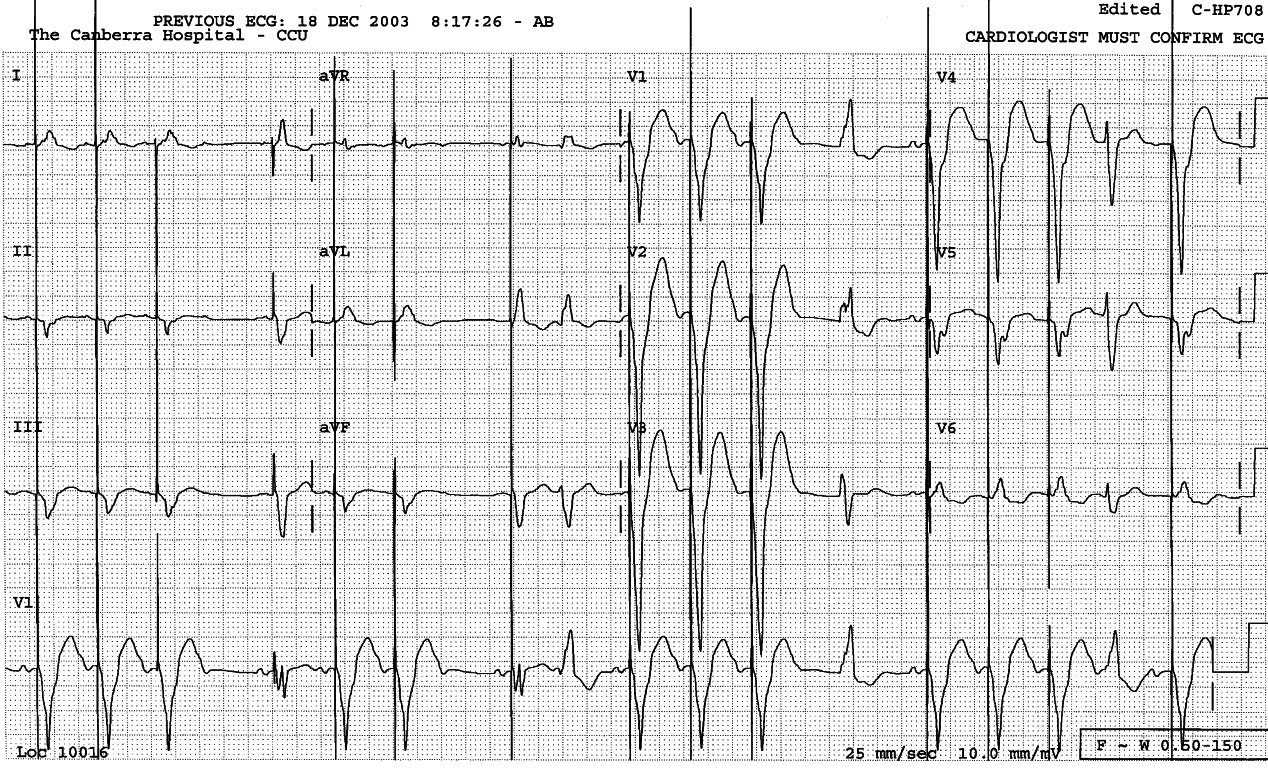 88 year old man in congestive heart failure.