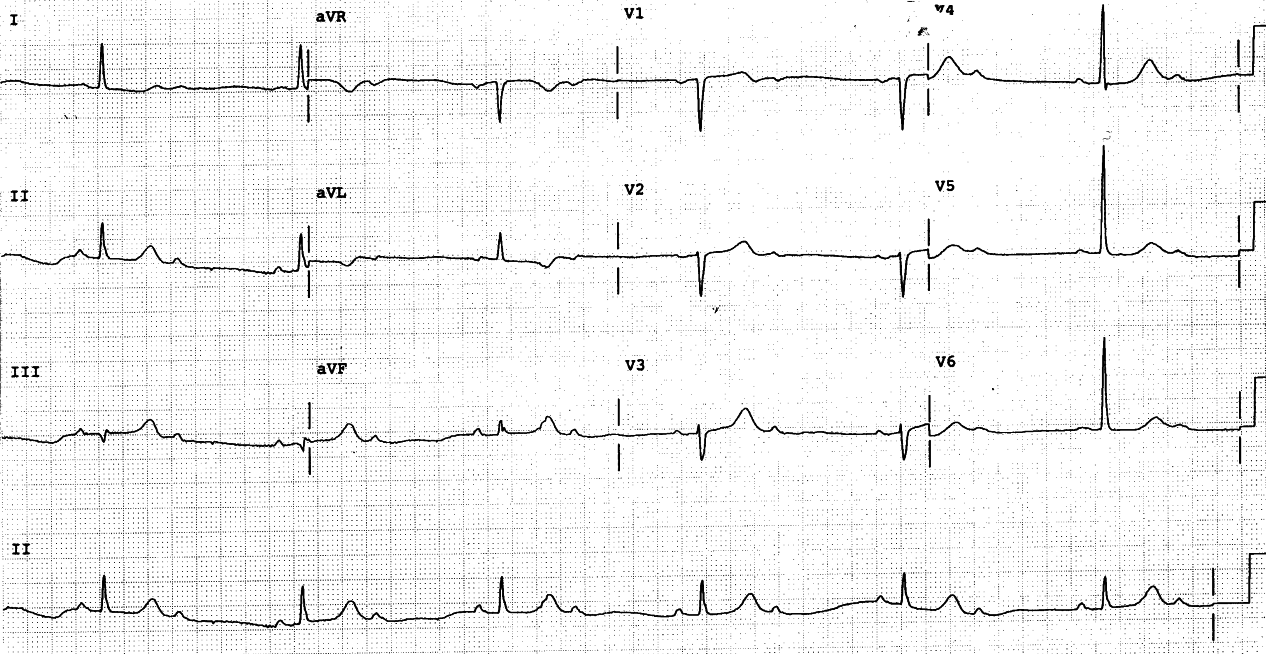 77 year old woman with the following Cardiologist's report:     "Sinus bradycardia. Prominent U waves." 